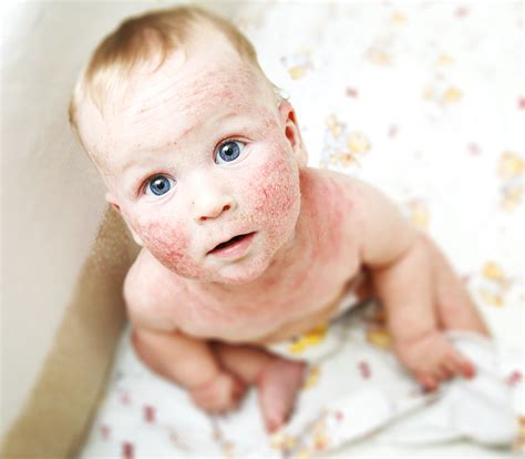 Neurodermitis gilt als autoimmunerkrankung, genauso wie allergien und heuschnupfen. Neurodermitis bei Babys und Kleinkindern: Ursachen ...