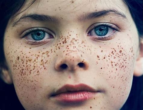 How to Get Rid of Freckles Fast, Naturally, Permanently ...
