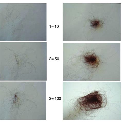 You could also try collecting the hairs you lose in a day, schmidt says, but that might feel significantly more tedious. Sinclair scale for female pattern hair loss. Stage 1 is ...
