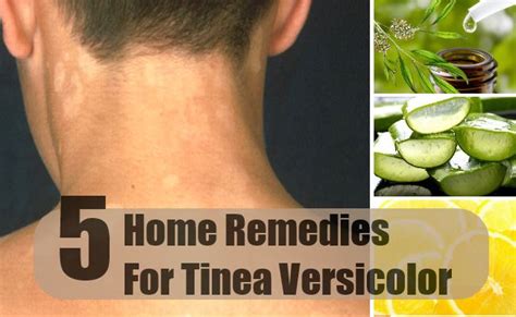 Tinea Versicolor Home Remedies Natural Treatments And Cure Find Home