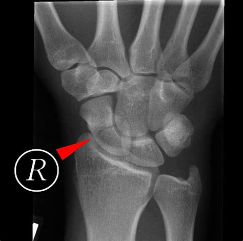 the short coat: HEELing The Scaphoid