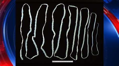 Medical Report 18 Year Old Dead After Tapeworm Infestation And