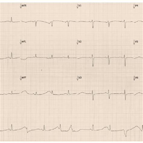 Electrocardiograma En Ritmo Sinusal Con Alternancia De La Onda T Y