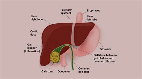 Gallbladder Inflammation Cholecystitis Causes Symptoms Sexiz Pix The