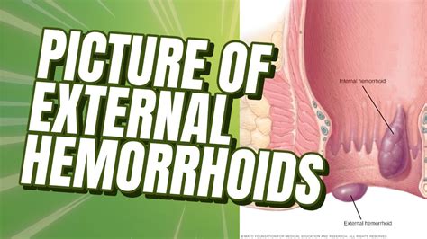 Picture Of External Hemorrhoid External Hemorrhoids Hem Healer