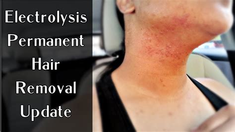 Electrolysis Permanent Hair Removal Prepost Treatment And Personal