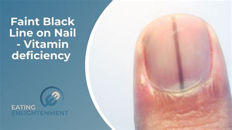 Faint Black Line On Nail Vitamin Deficiency In 2022 Lines On Nails Vitamin Deficiency Nail