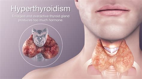 Hyperthyroidism Overactive Thyroid Causes Symptoms And Treatment