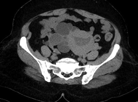 contrast enhanced computed tomography of the pelvis showing the uterus download scientific