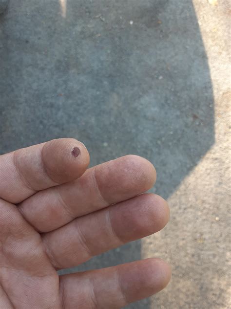 My Blood Blister Thats To Deep To Pop With A Needle Coming To The