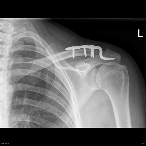 Acromioclavicular Joint Dislocation Image Radiopaedia Org
