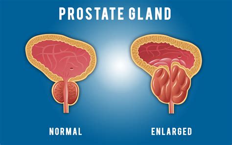 Prostate Gland H Kkp