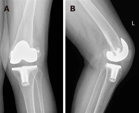 Re Revision Surgery For Re Recurrent Valgus Deformity After Revision