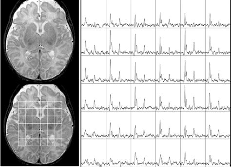 The Normal Neonatal Brain Mr Imaging Diffusion Tensor Imaging And 3d