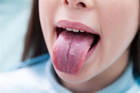 Fissured Geographic Tongue