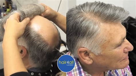 Before And After Hair System Non Surgical Hair Replacement System Men Women Uk Usa
