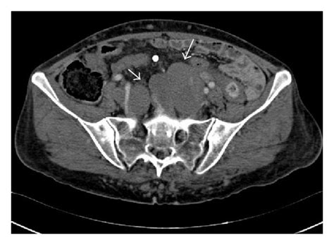 Axial Contrast Enhanced Arterial Phase Ct Of The Pelvis Demonstrating