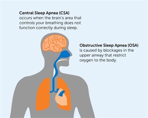 Types Of Sleep Apnea Obstructive Vs Central