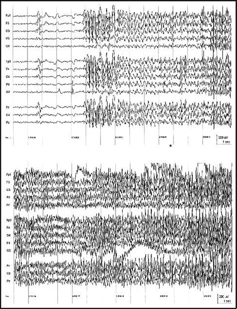 Jle Epileptic Disorders Video‐eeg Evidence Of Lateralized Clinical