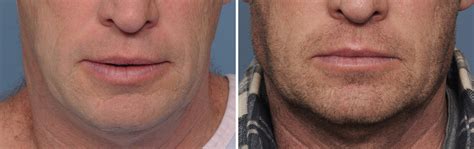 Standard Vertical Lengthening Jaw Angle Implants Result Front View Dr