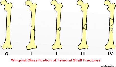 Ao Classification Femur Fracture