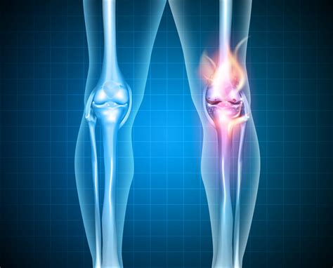 Knee Arthritis Treatment Osteoarthritis Symptoms Causes Advice