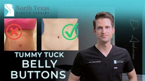 Belly Buttons The Most Important Part Of A Tummy Tuck Youtube