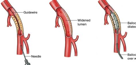 It will not induce unconsciousness. PERIPHERAL ANGIOGRAPHY AND ANGIOPLASTY | Dr. Tejas V ...