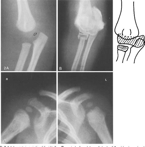 Occult Humeral Epiphyseal Fracture In Battered Infants Semantic Scholar