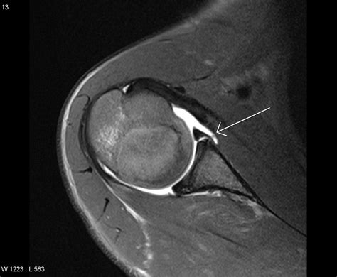 Mri Glenoid Cartilage Where What To Look For Shoulder Dislocations My