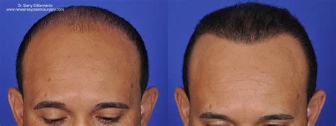 Smartgraft Hair Transplant Before And After Photos Patient 35 Houston