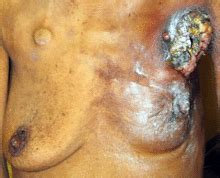 What should i do if i find a breast lump? Kanser sa suso - Wikipedia, ang malayang ensiklopedya