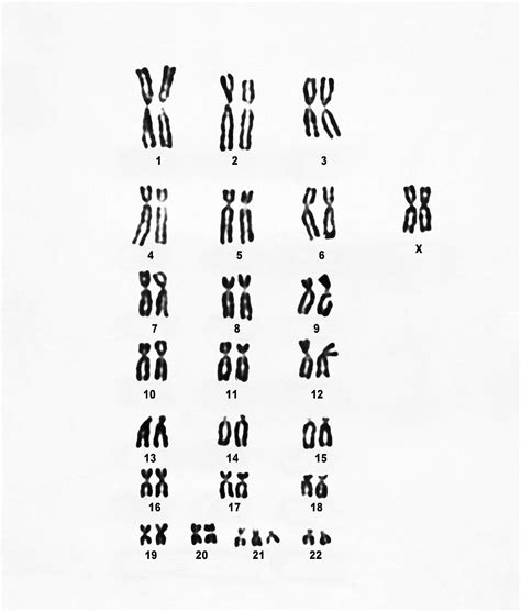 female karyotype showing down s syndrome bild kaufen 12026070 science photo library