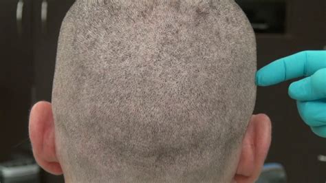 Fue Hair Transplant Scar In Donor Area Dr Diep In Bay Area