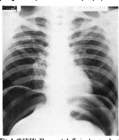 Figure 3 From Encysted Diaphragmatic Pleural Effusion Semantic Scholar