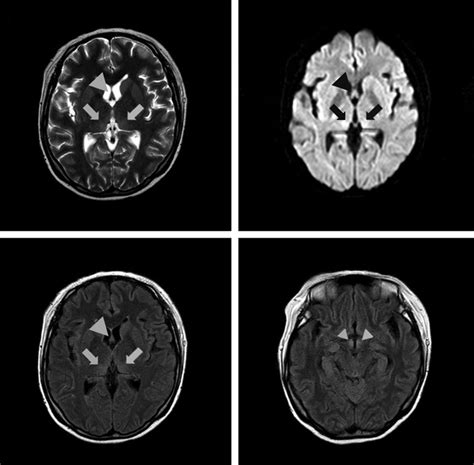 Initial Brain Magnetic Resonance Imaging Findings T2 Weighted Imaging