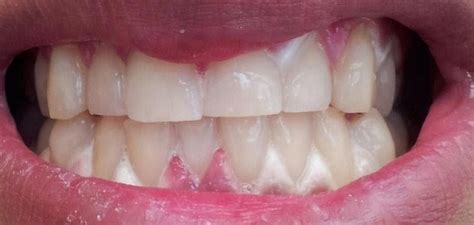 My Gums Are White After Teeth Whitening Teethwalls