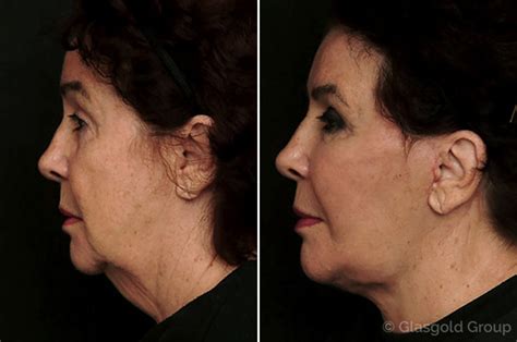 Facelift Before And After Princeton Nj Page 5 Of 7