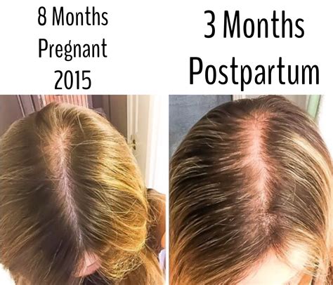 Women And Hair Loss Causes Solutions And Support First Thyme Mom