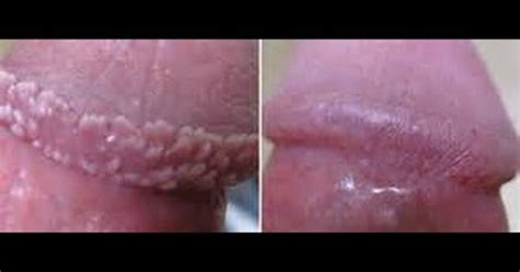 Find over 100+ of the best free sign images. http://papulesremoval.plus101.com/ ---Pearly Penile ...