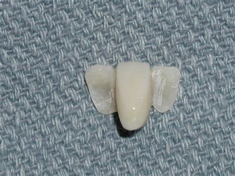 This is often used to replace front teeth. Maryland Bridge Archives - Dr. Paul Caputo Comprehensive Dentist Palm Harbor | Dental bridge ...