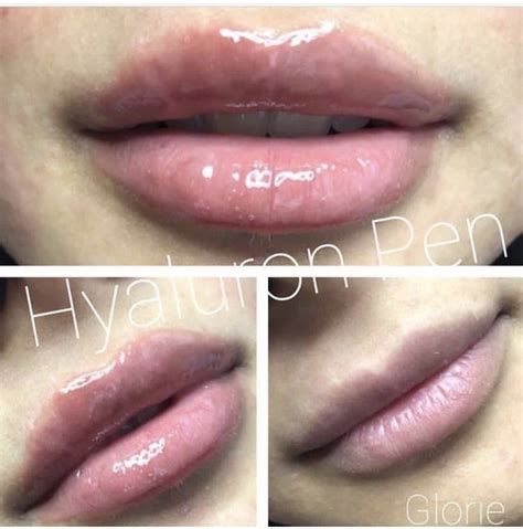 Hyaluron pen training tips that are must haves! Pin on Lip Filler