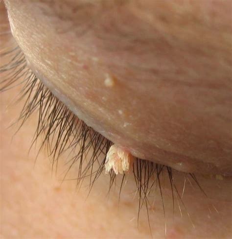 Filiform Warts What They Look Like Treatment And Causes