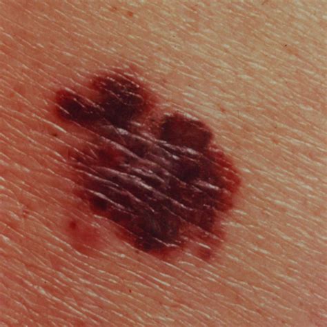 What Does Melanoma Look Like Skin Cancer Youtube