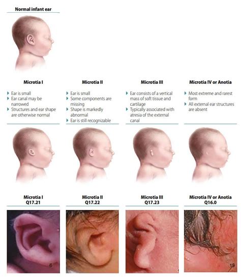 Congenital Anomalies Of The Ear Microtiaanotia Ncbddd Cdc