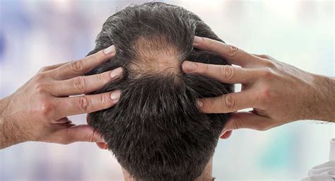 Please inform your prescribing physician. Hair Loss - Dr Sandra Cabot MD