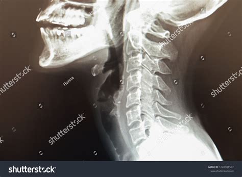 Normal Cervical Spine Girl Xray Cervical ภาพสต็อก 1228981537 Shutterstock