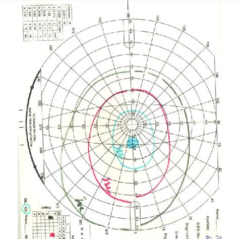 B Goldmann Visual Field Charting Showing Baring And Enlargement Of