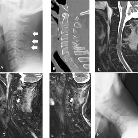 Assessment Of Cervical Spine Injury Via Magnetic Resonance Imaging