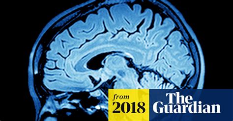 Scientists Seek Drug To ‘rewire Adult Brain After Stroke Stroke